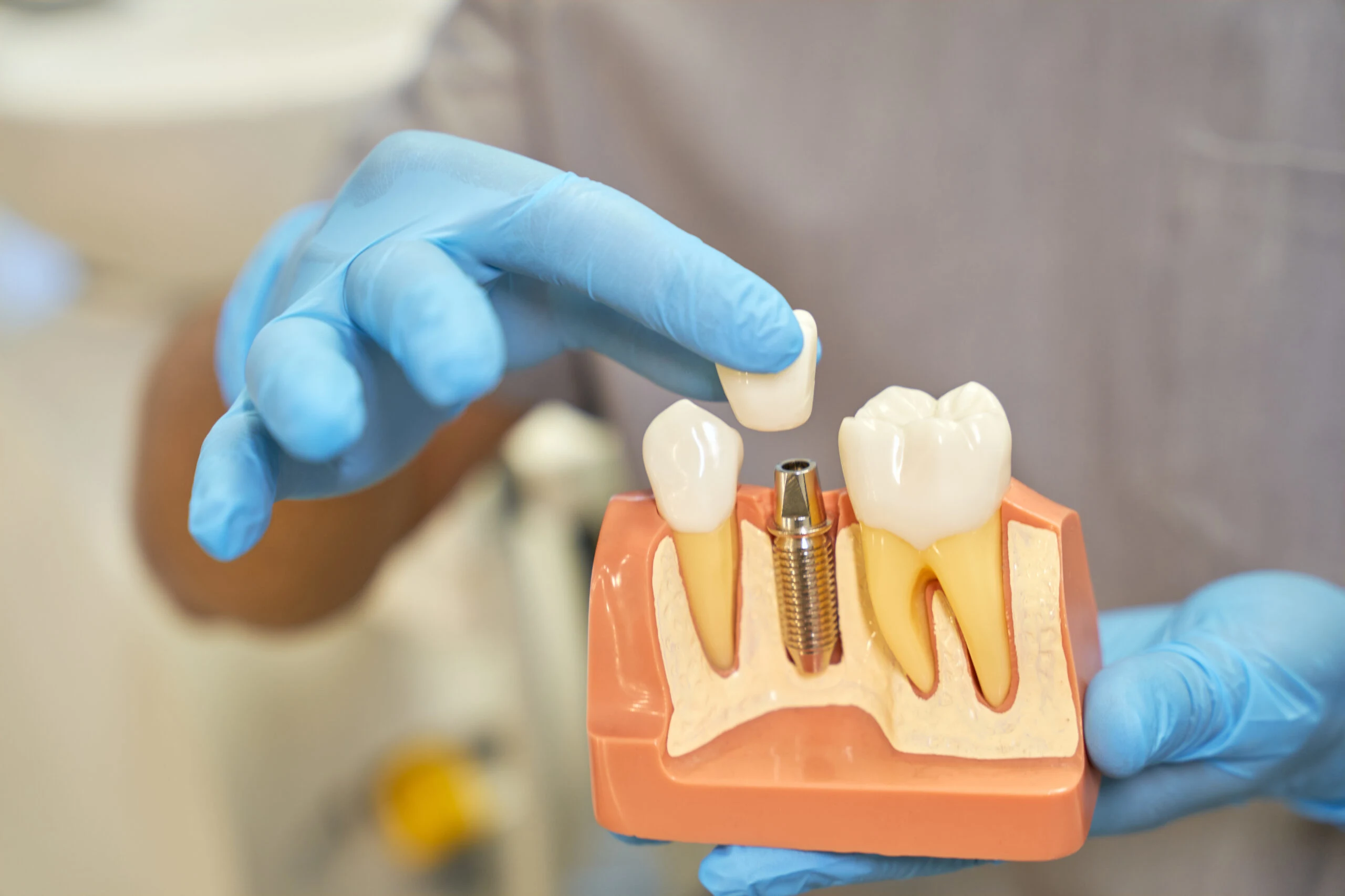 Understanding Dental Implants: What You Need to Know