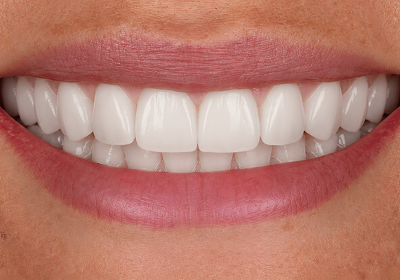 Dental implants After 2