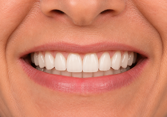 Dental implants After