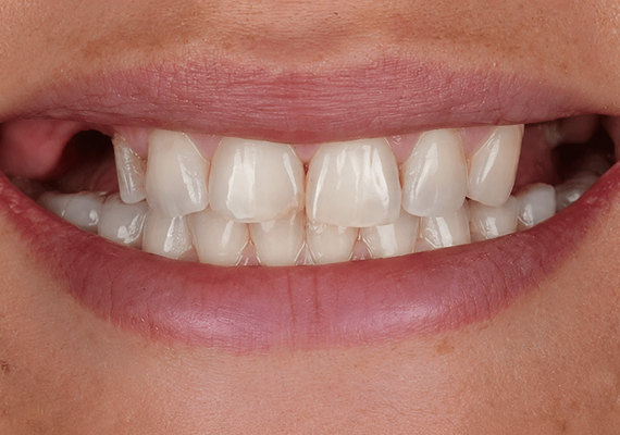 Dental implants Before 2