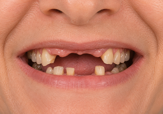 Dental implants Before