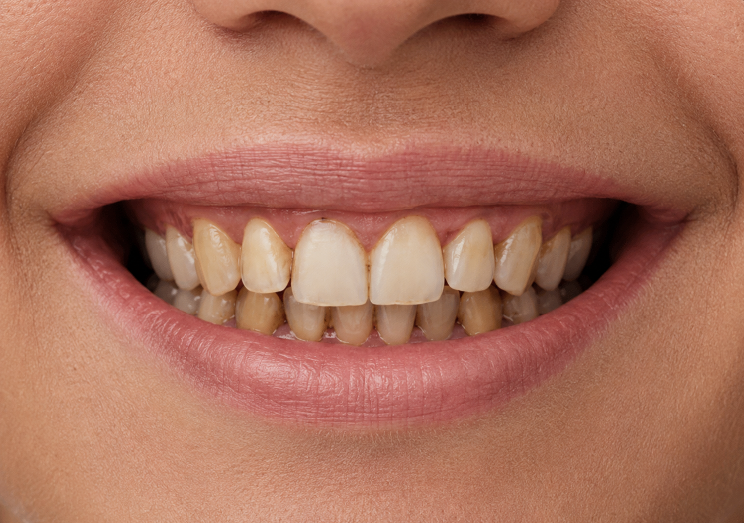 Smile makeover Before