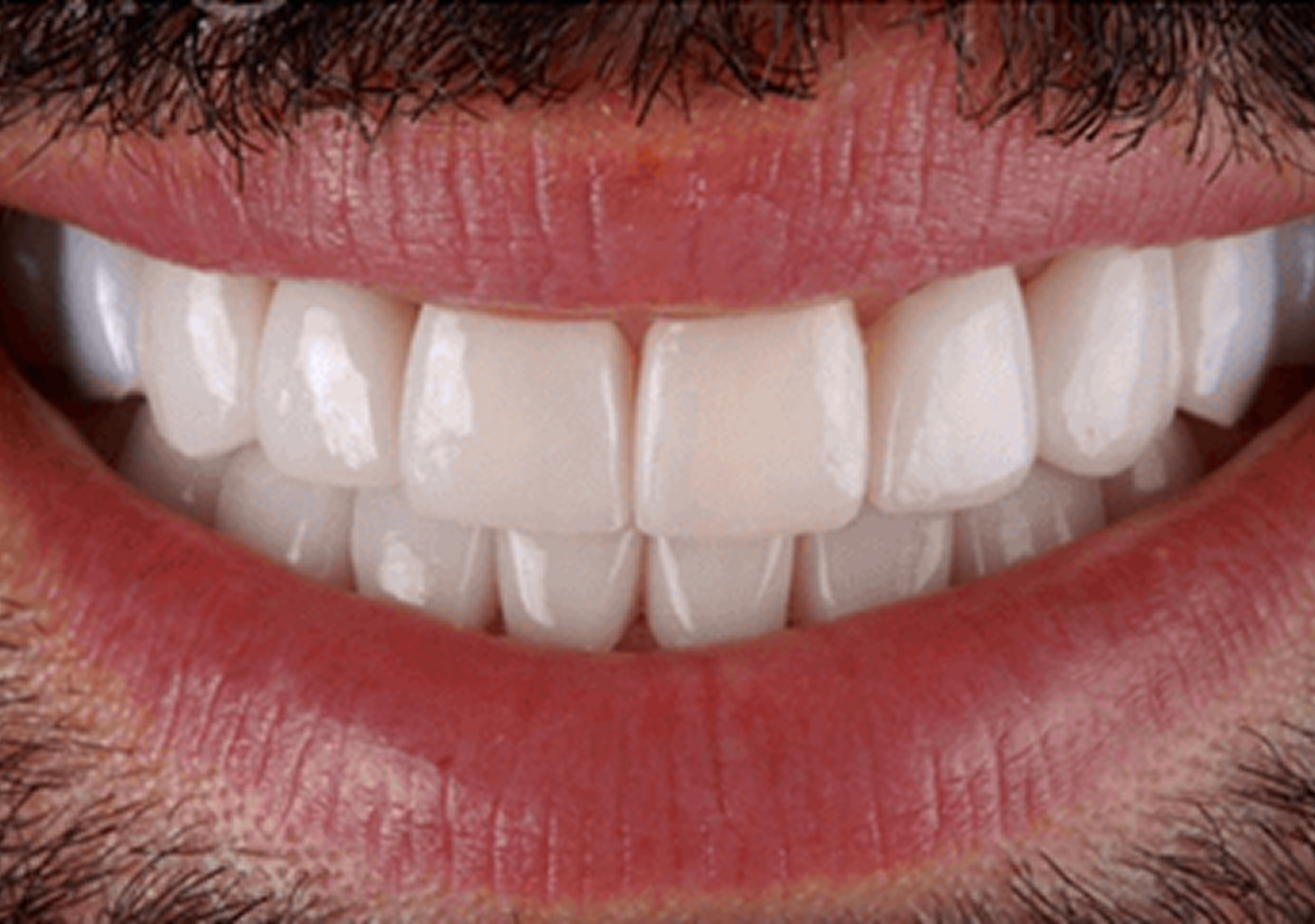 smile makeover 02 (1)