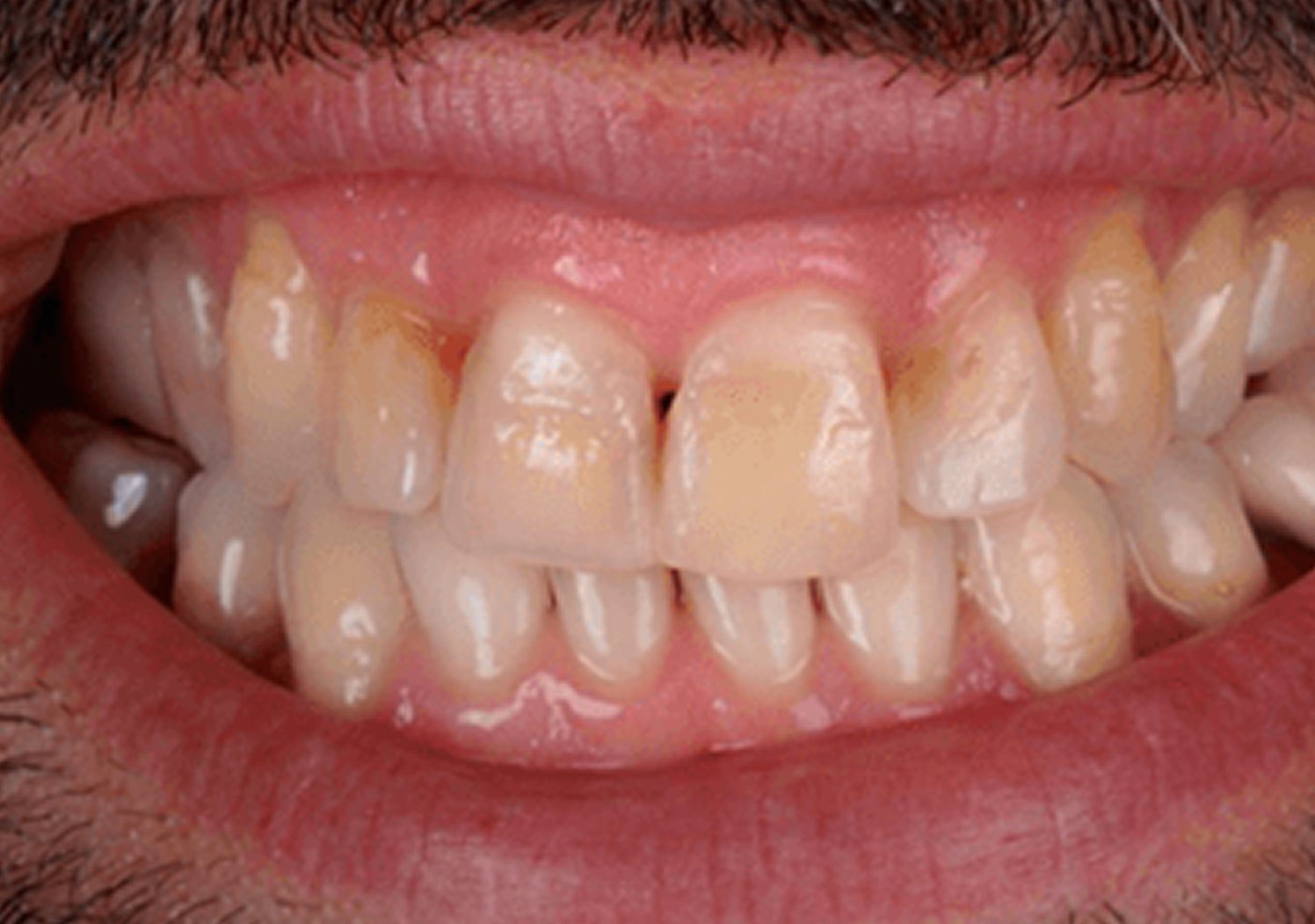smile makeover 02